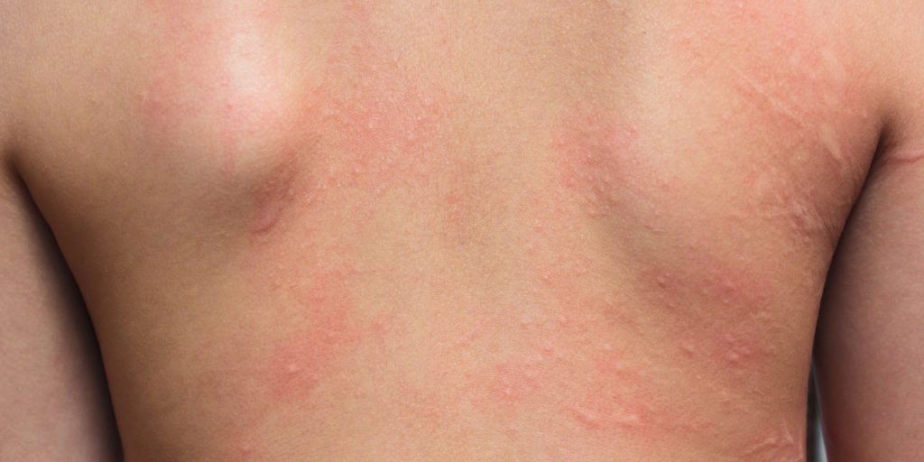 Alergias Cutâneas Alergia E Imunologia